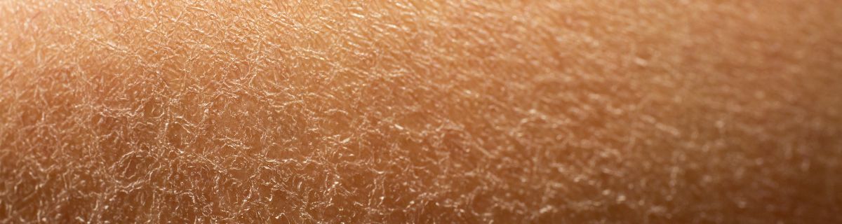 piel seca y cómo recuperarla de forma efectiva